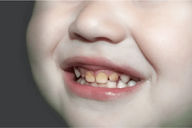 Tooth decay in children Causes, signs and treatment